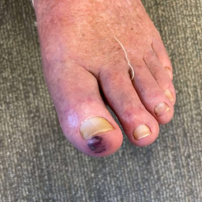 Diabetic Foot