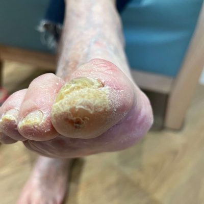 Geriatric Foot 4